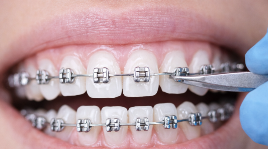 We Care Dental affortable braces Png